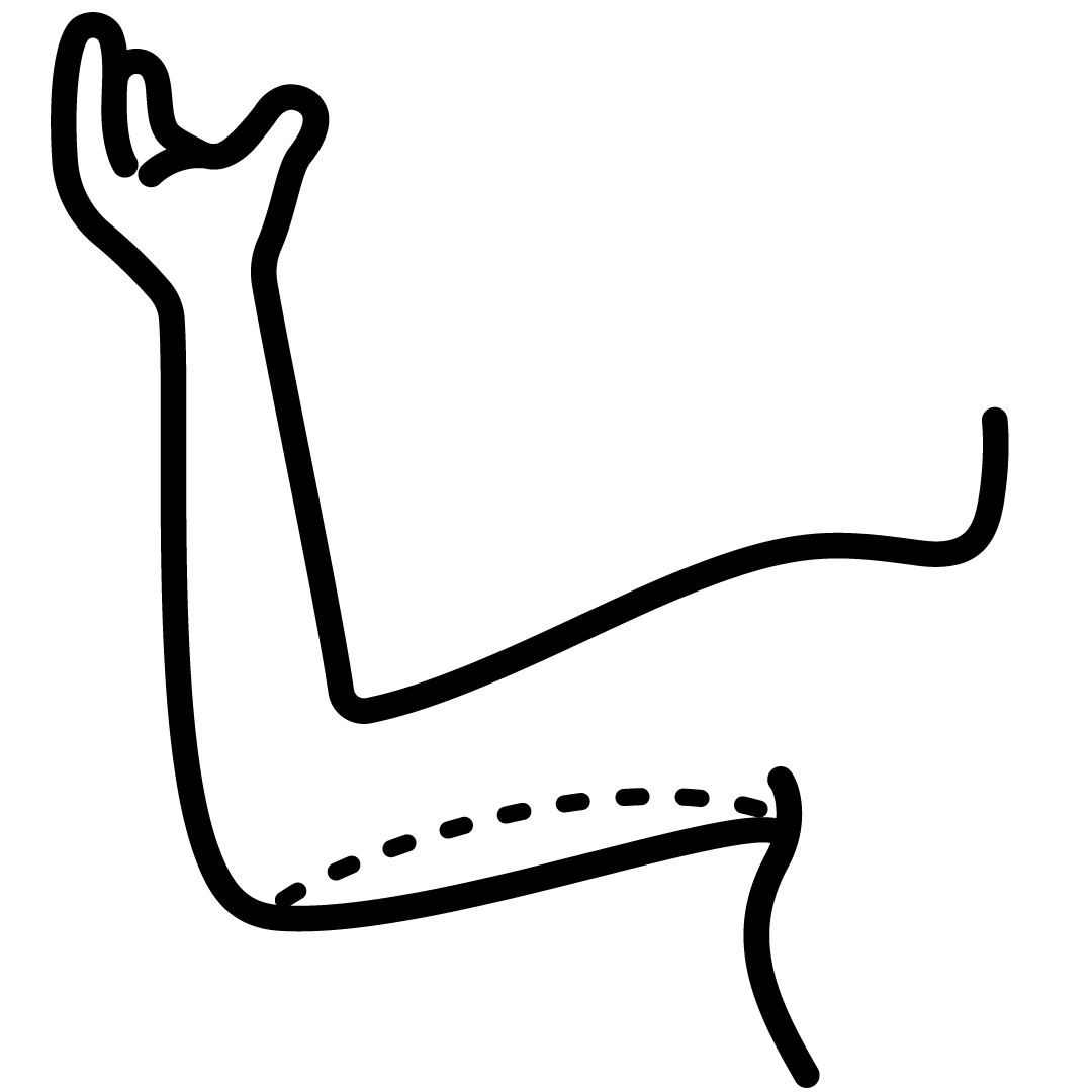 Cirurgia de braço