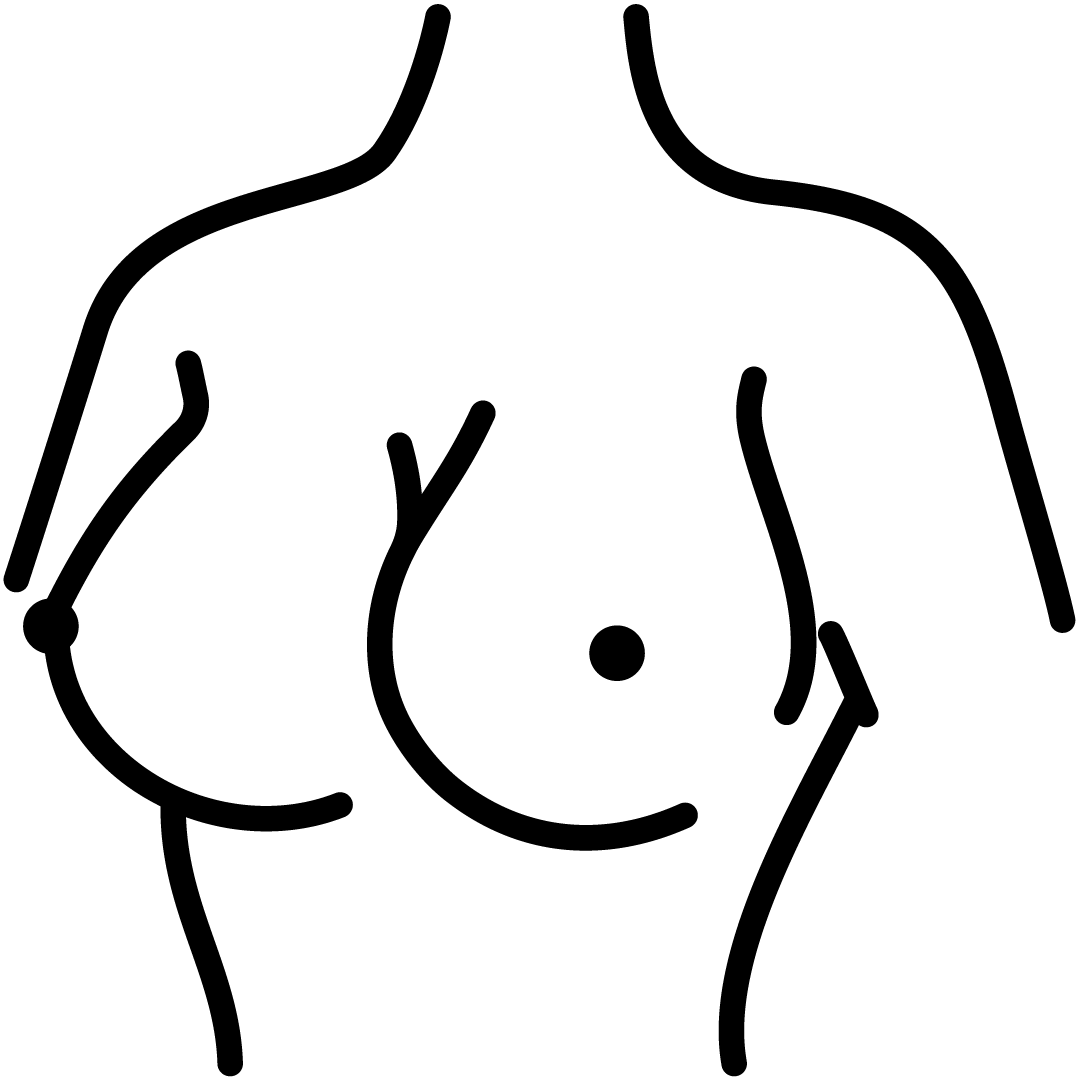 Mamoplastia
