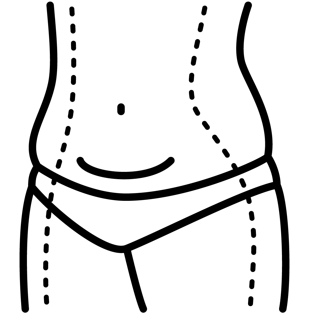 Lipoaspiração