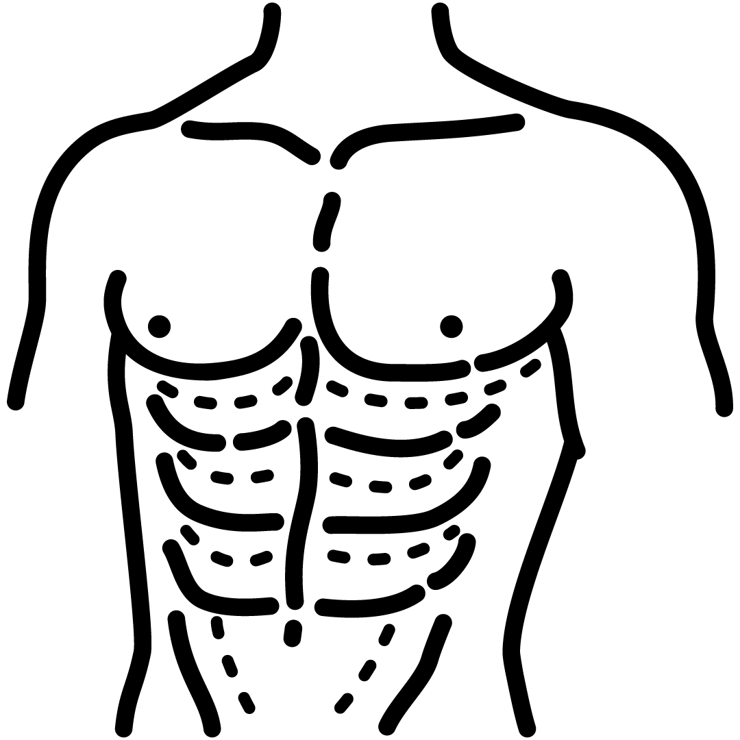 Abdominoplastia