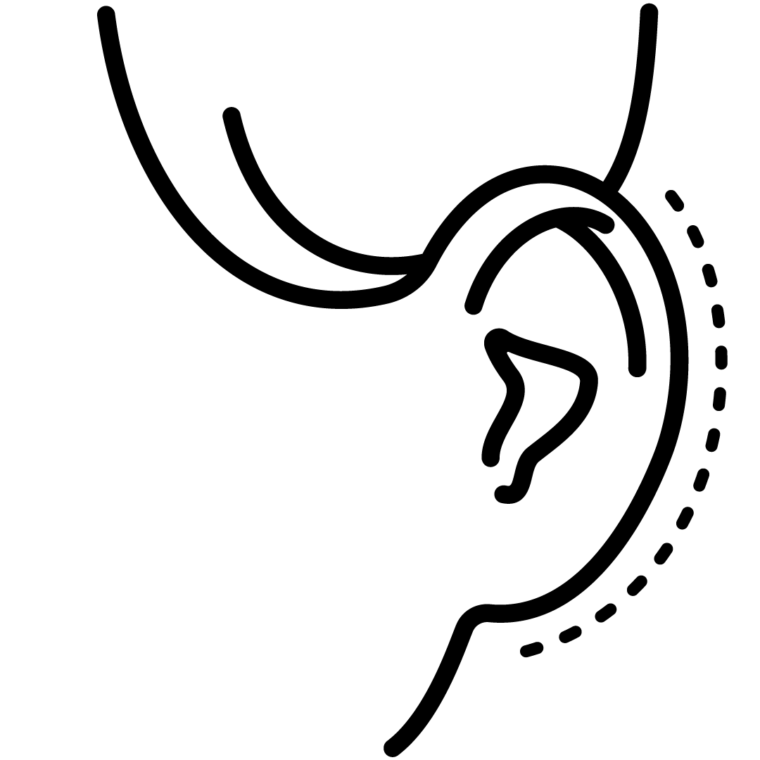 Otoplastia