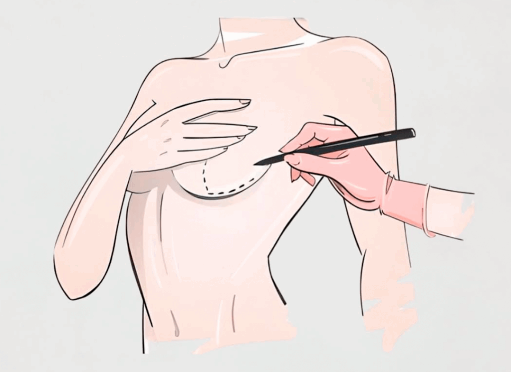 Você já pensou em levantar e remodelar suas mamas, mas ficou insegura por causa da cicatriz?
